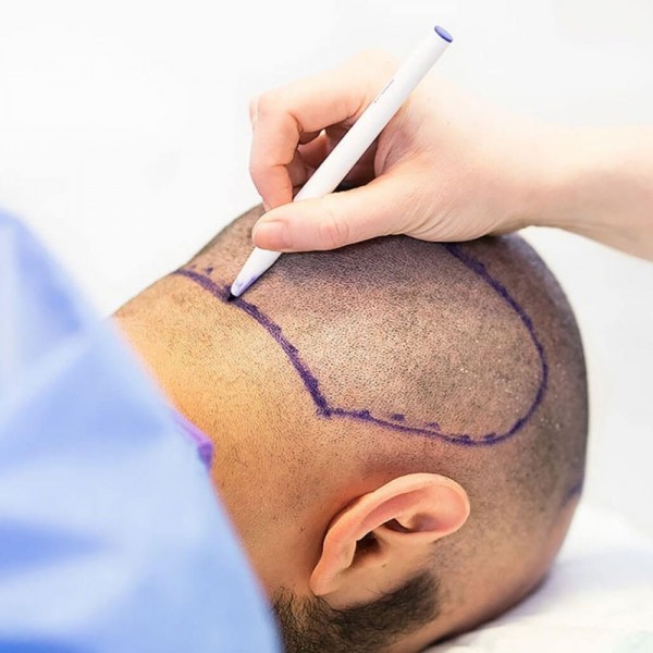 FUE Hair Transplant 1