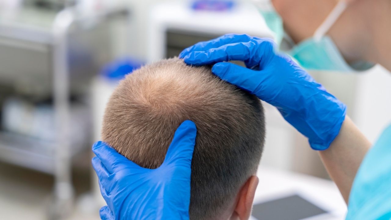  FUE Hair Transplant Turkey 